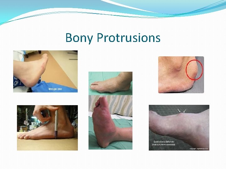 Bony Protrusions 