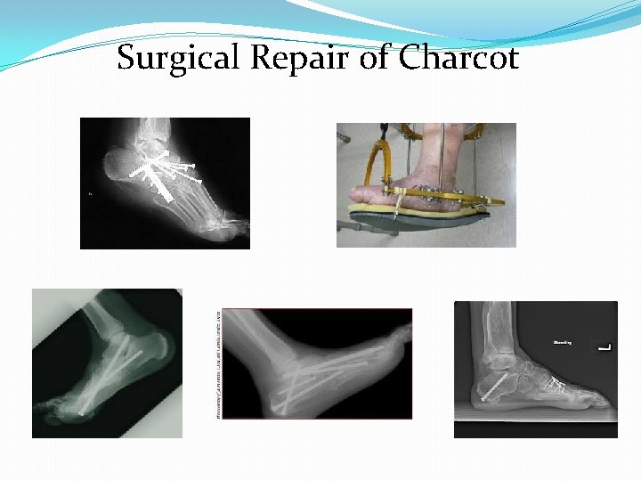 Surgical Repair of Charcot 