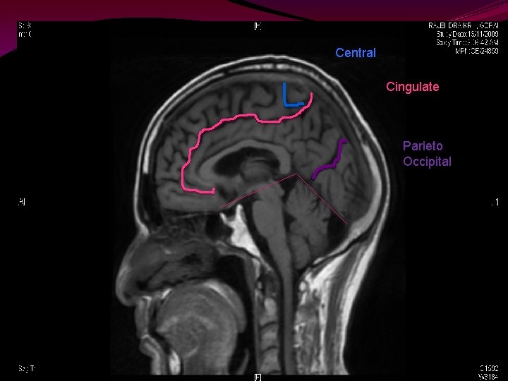 Central Cingulate Parieto Occipital 