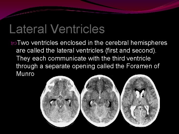 Lateral Ventricles Two ventricles enclosed in the cerebral hemispheres are called the lateral ventricles
