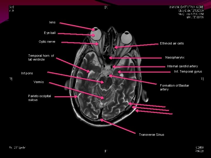 lens Eye ball Optic nerve Ethmoid air cells Temporal horn of lat ventricle Nasopharynx