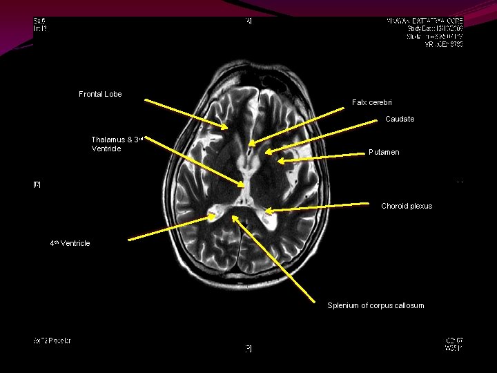 # Frontal Lobe Falx cerebri Caudate Thalamus & 3 rd Ventricle Putamen Choroid plexus