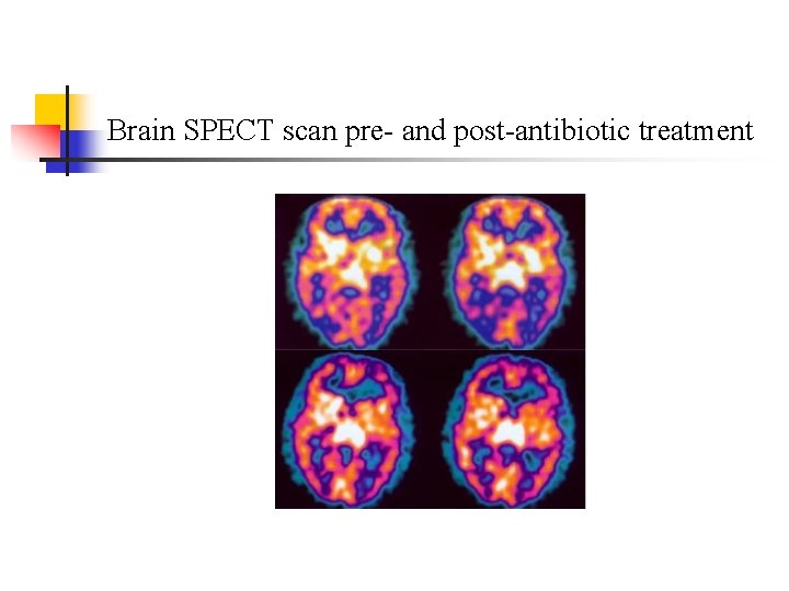 Brain SPECT scan pre- and post-antibiotic treatment 