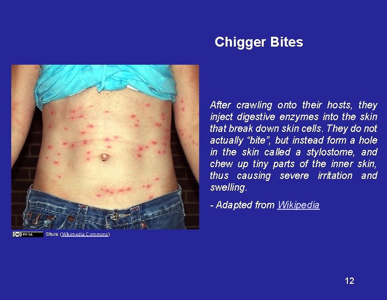 Chigger Bites After crawling onto their hosts, they inject digestive enzymes into the skin