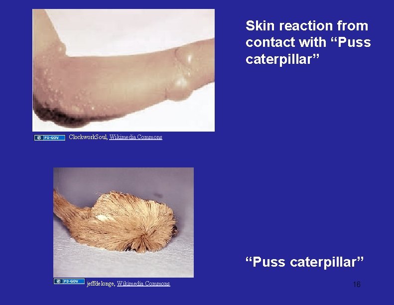 Skin reaction from contact with “Puss caterpillar” Clockwork. Soul, Wikimedia Commons “Puss caterpillar” jeffdelonge,