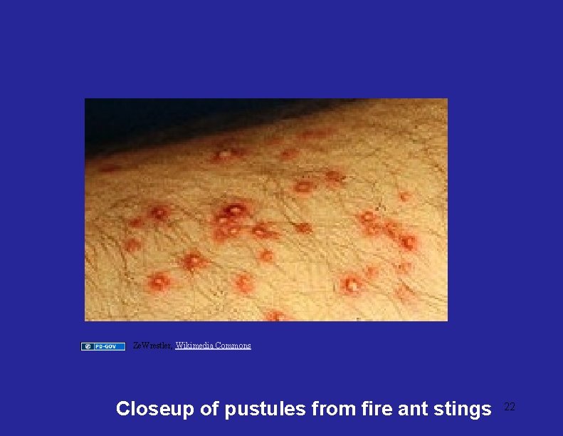 Ze. Wrestler, Wikimedia Commons Closeup of pustules from fire ant stings 22 