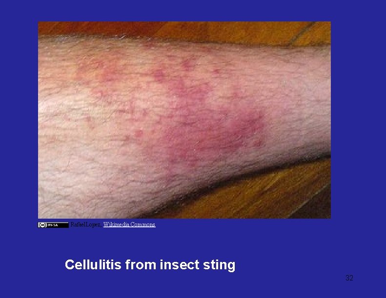 Rafael. Lopez, Wikimedia Commons Cellulitis from insect sting 32 