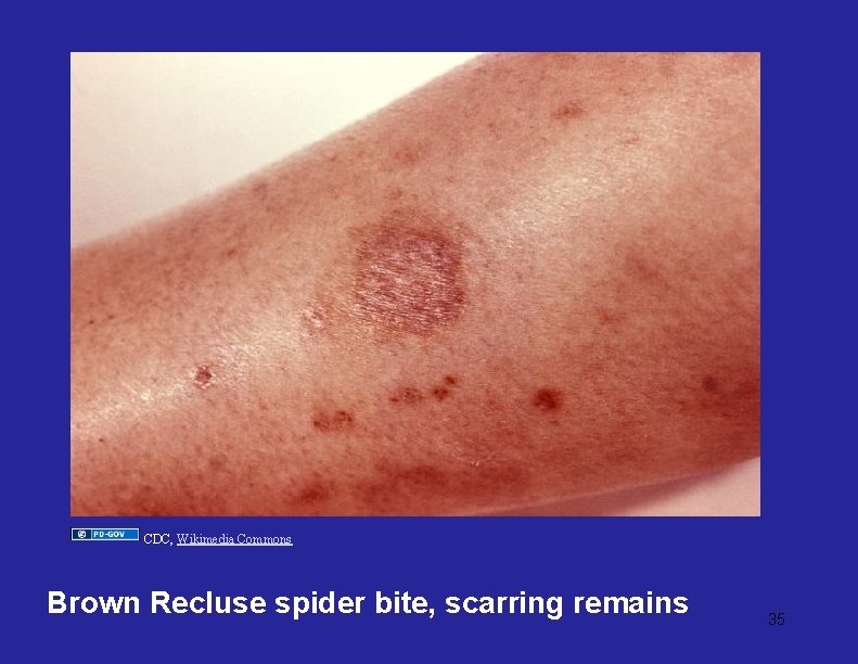 CDC, Wikimedia Commons Brown Recluse spider bite, scarring remains 35 