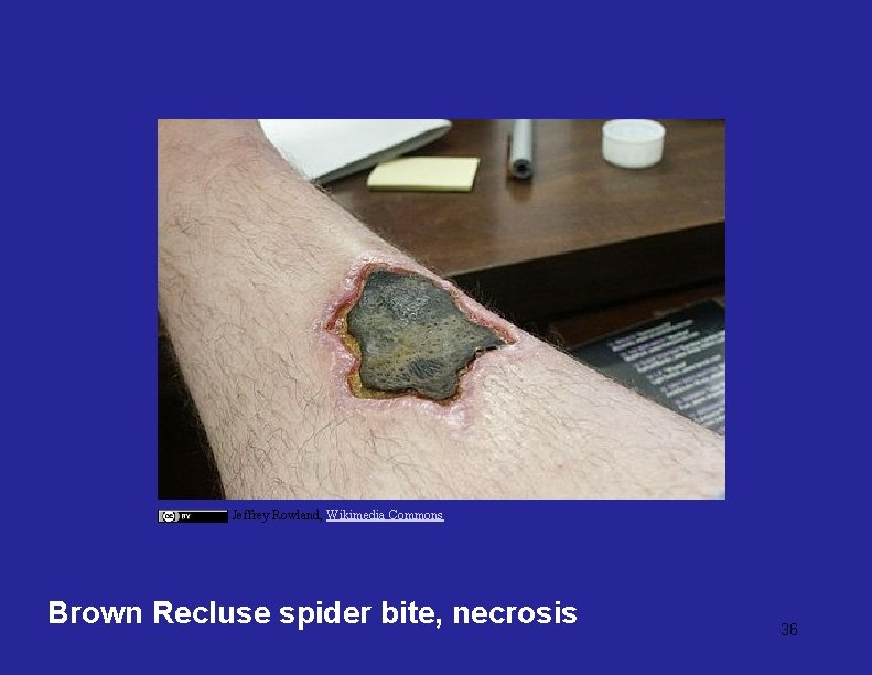 Jeffrey Rowland, Wikimedia Commons Brown Recluse spider bite, necrosis 36 