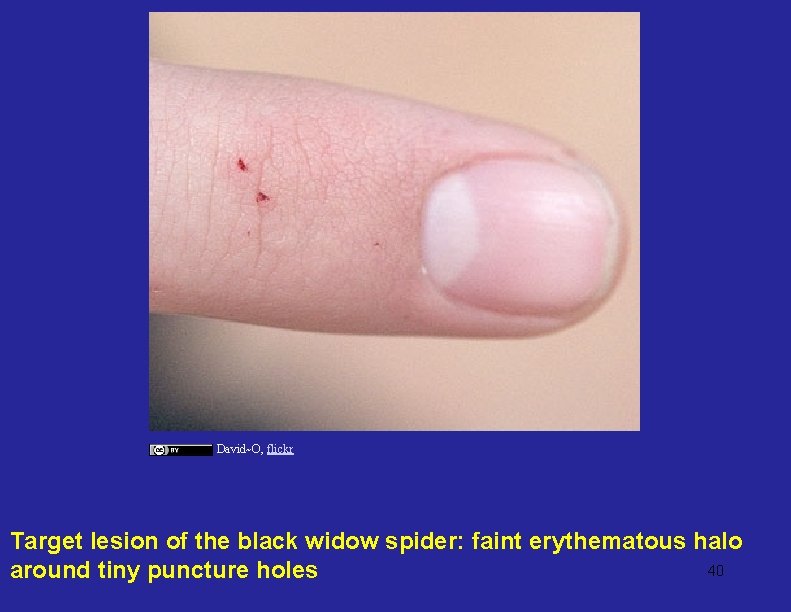 David~O, flickr Target lesion of the black widow spider: faint erythematous halo 40 around