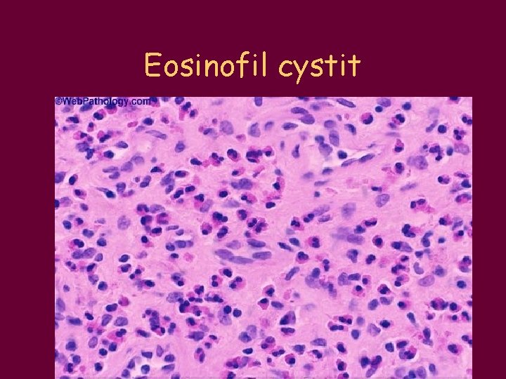 Eosinofil cystit 