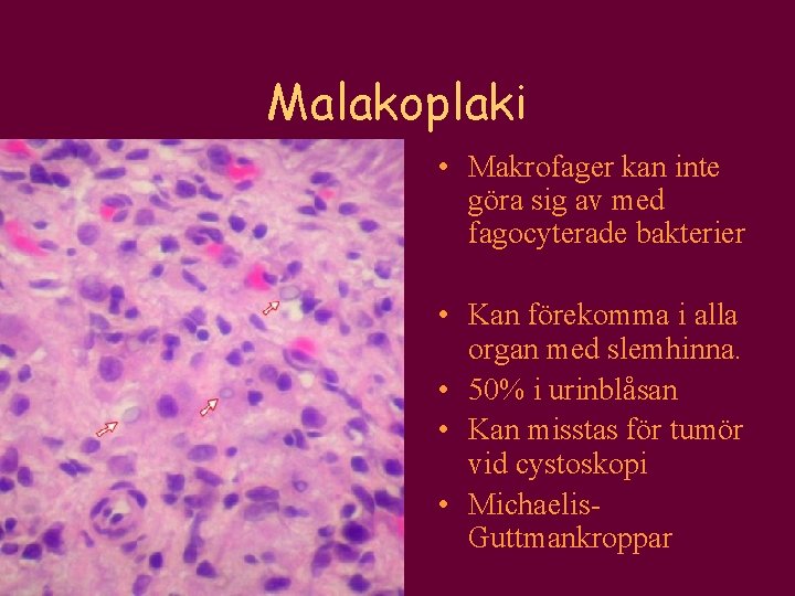 Malakoplaki • Makrofager kan inte göra sig av med fagocyterade bakterier • Kan förekomma