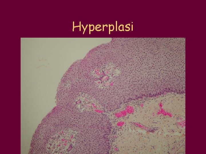 Hyperplasi 