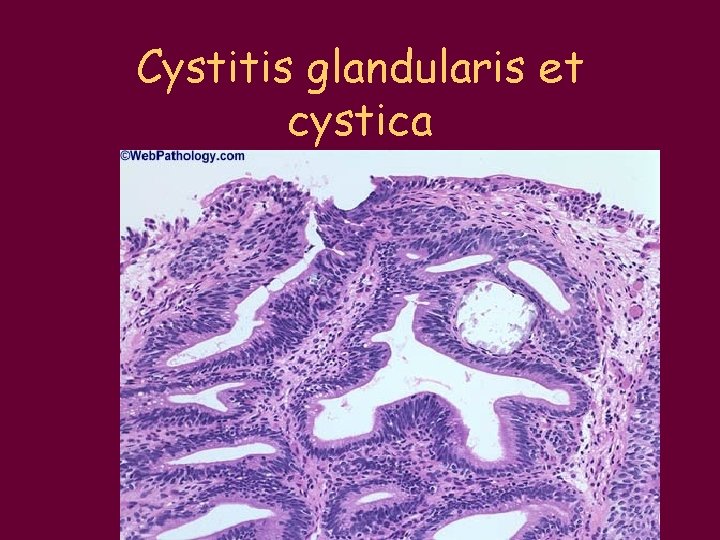 Cystitis glandularis et cystica 