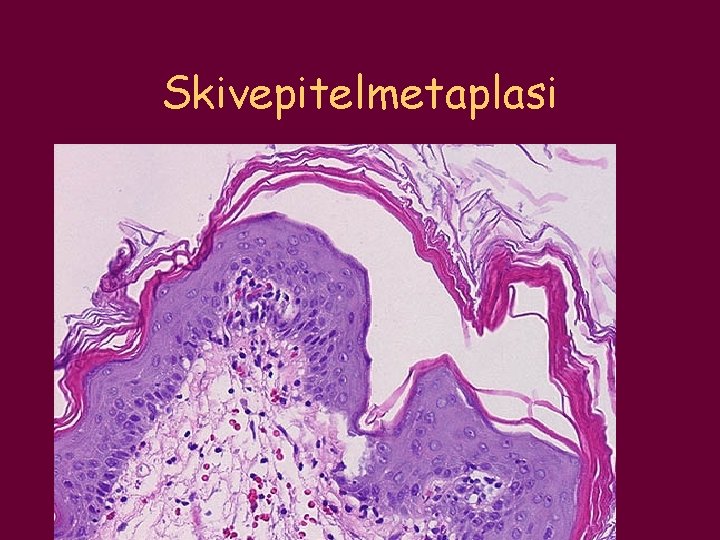 Skivepitelmetaplasi 
