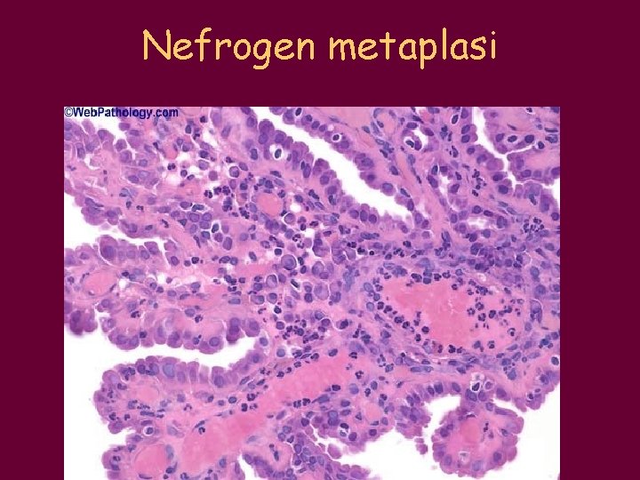 Nefrogen metaplasi 