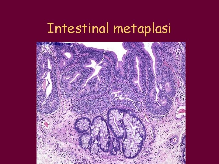 Intestinal metaplasi 