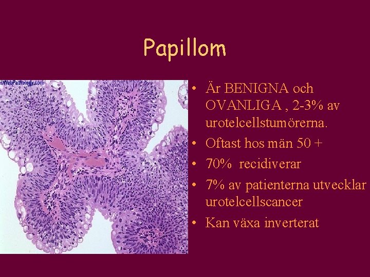 Papillom • Är BENIGNA och OVANLIGA , 2 -3% av urotelcellstumörerna. • Oftast hos