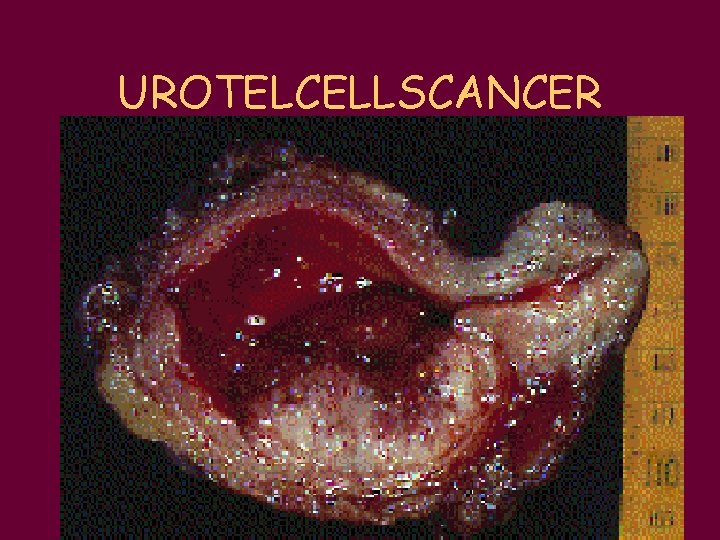 UROTELCELLSCANCER 