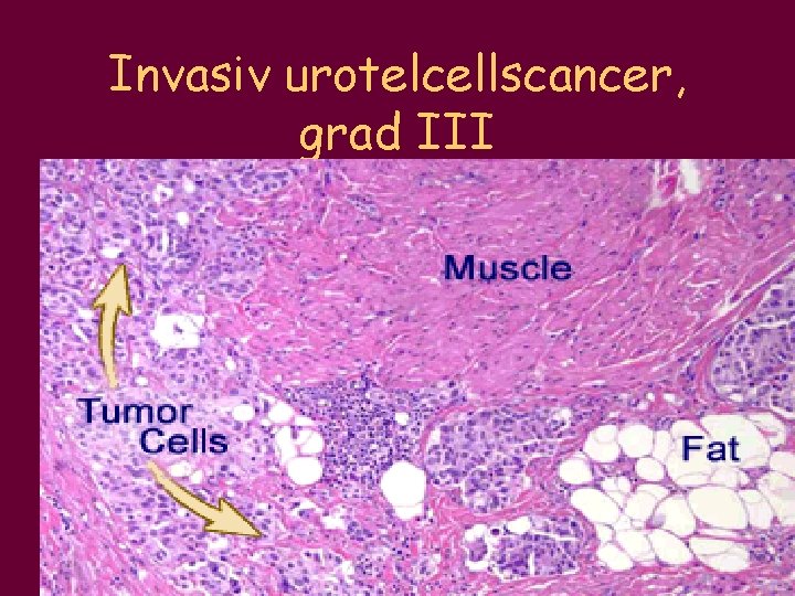 Invasiv urotelcellscancer, grad III 