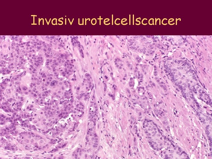 Invasiv urotelcellscancer 