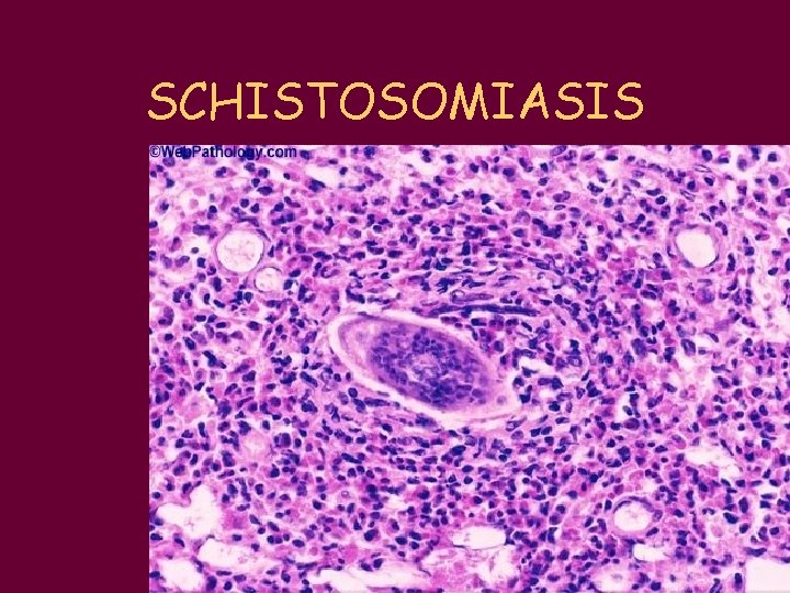 SCHISTOSOMIASIS 