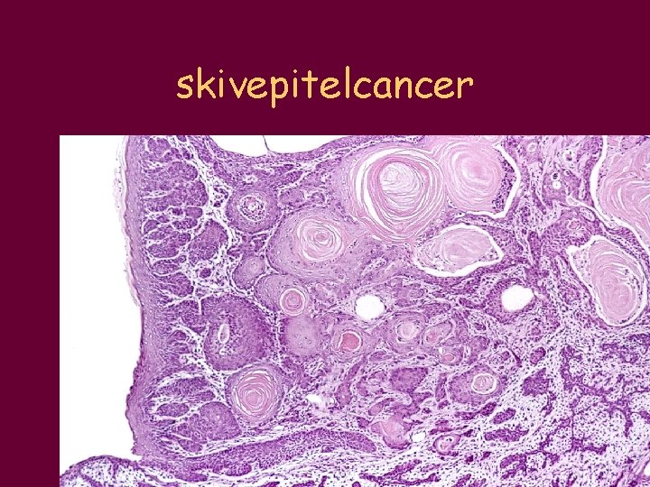 skivepitelcancer 