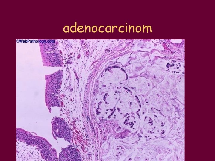 adenocarcinom 