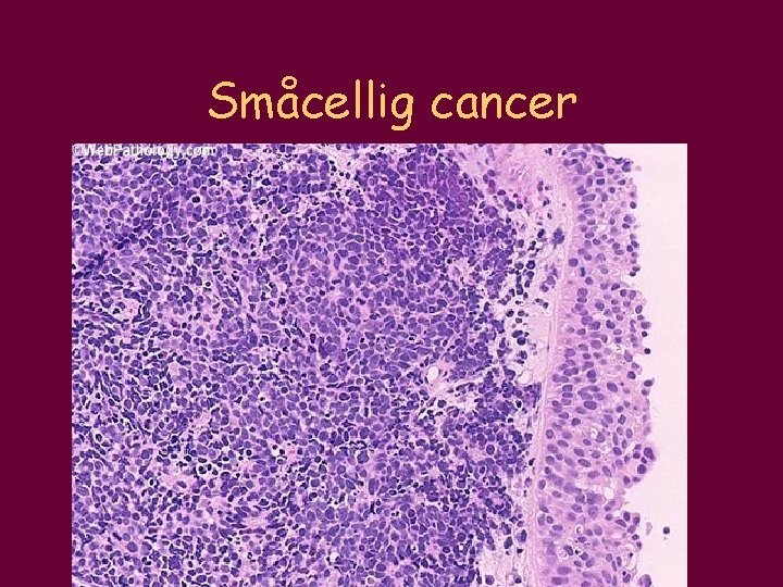 Småcellig cancer 