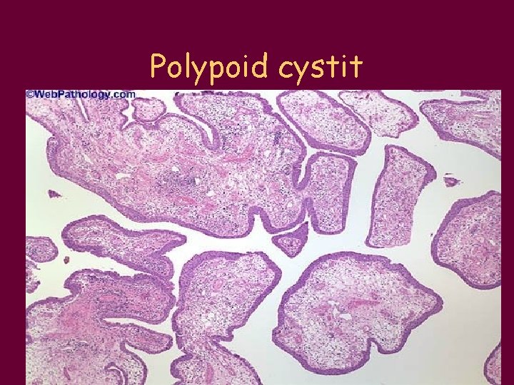 Polypoid cystit • 