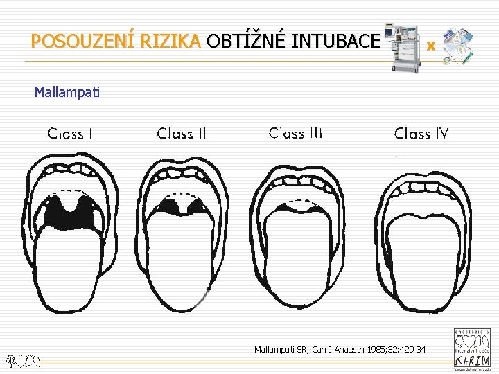 POSOUZENÍ RIZIKA OBTÍŽNÉ INTUBACE Mallampati SR, Can J Anaesth 1985; 32: 429 -34 x