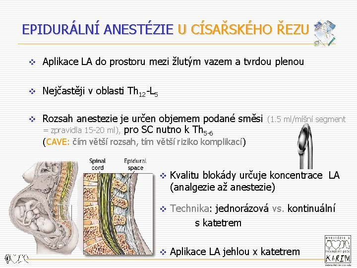 EPIDURÁLNÍ ANESTÉZIE U CÍSAŘSKÉHO ŘEZU v Aplikace LA do prostoru mezi žlutým vazem a