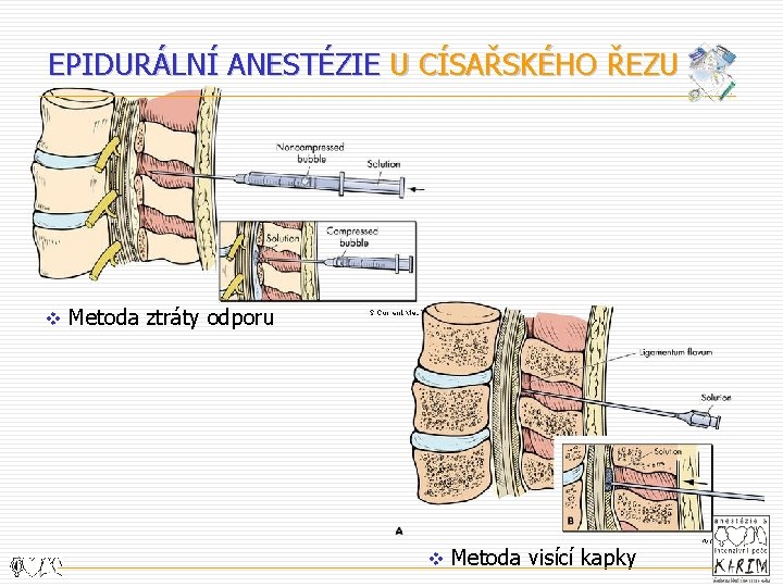 EPIDURÁLNÍ ANESTÉZIE U CÍSAŘSKÉHO ŘEZU v Metoda ztráty odporu v Metoda visící kapky 