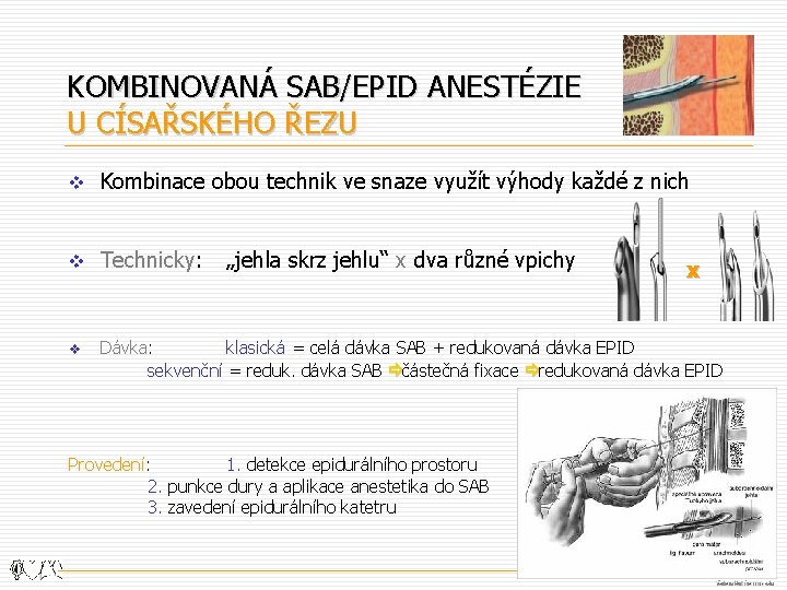 KOMBINOVANÁ SAB/EPID ANESTÉZIE U CÍSAŘSKÉHO ŘEZU v Kombinace obou technik ve snaze využít výhody