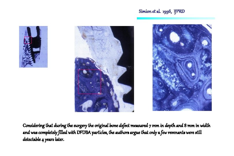 Simion et al. 1996, IJPRD Considering that during the surgery the original bone defect