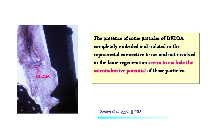 The presence of some particles of DFDBA completely embeded and isolated in the supracrestal