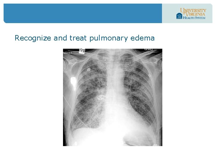 Recognize and treat pulmonary edema 