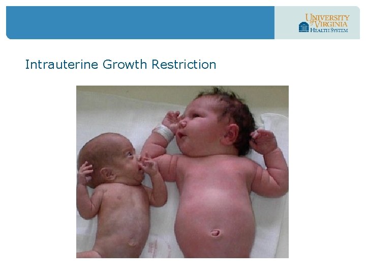 Intrauterine Growth Restriction 