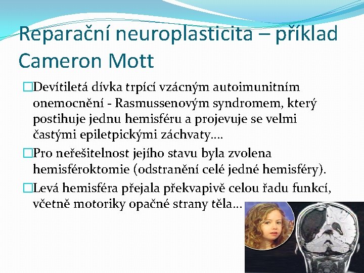 Reparační neuroplasticita – příklad Cameron Mott �Devítiletá dívka trpící vzácným autoimunitním onemocnění - Rasmussenovým