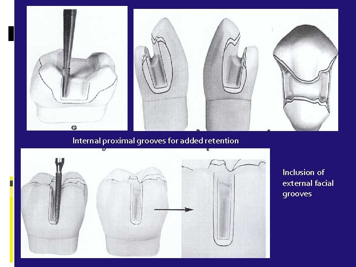  Internal proximal grooves for added retention Inclusion of external facial grooves 