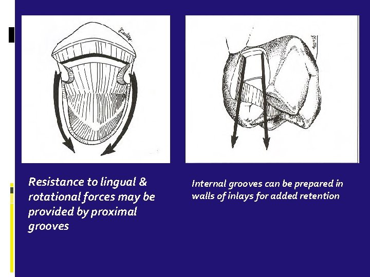 Resistance to lingual & rotational forces may be provided by proximal grooves Internal grooves