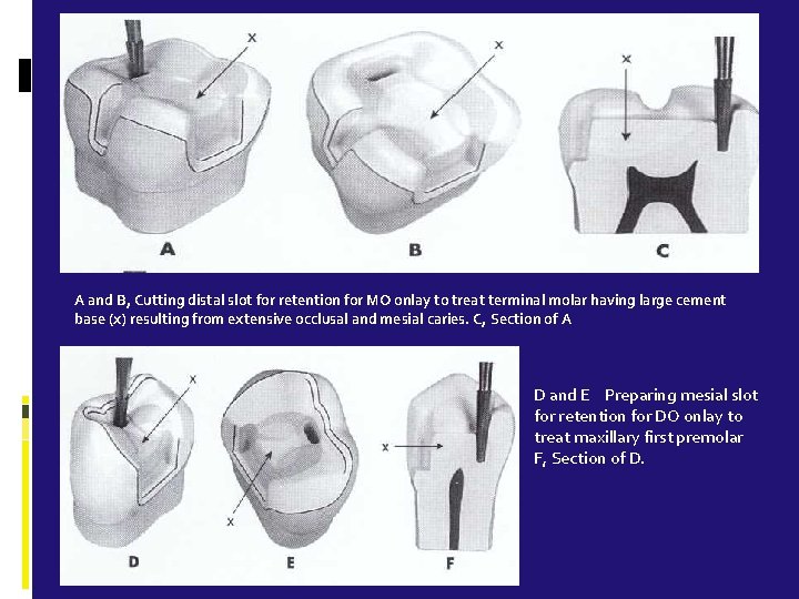 A and B, Cutting distal slot for retention for MO onlay to treat terminal