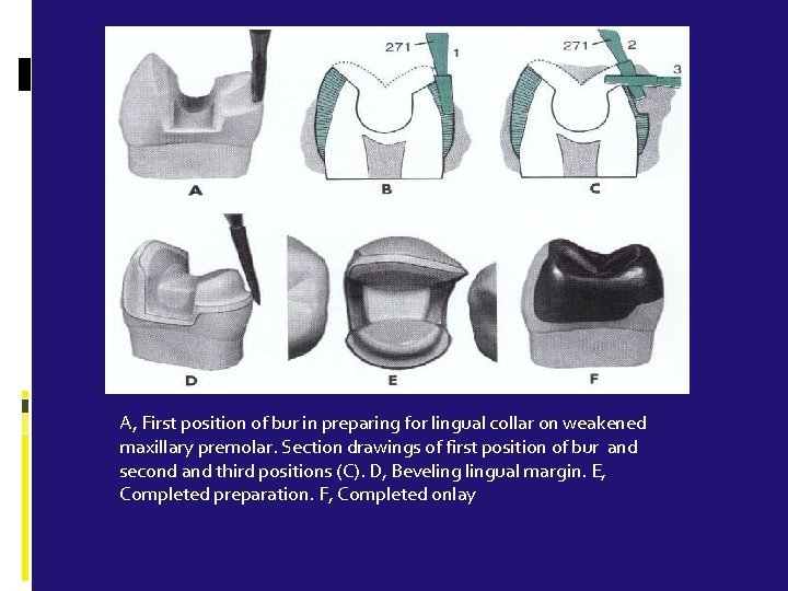 A, First position of bur in preparing for lingual collar on weakened maxillary premolar.