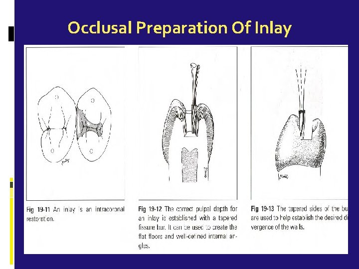 Occlusal Preparation Of Inlay 