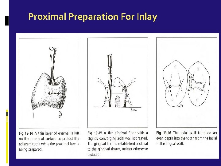 Proximal Preparation For Inlay 