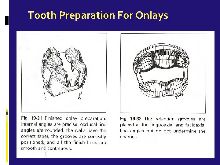 Tooth Preparation For Onlays 