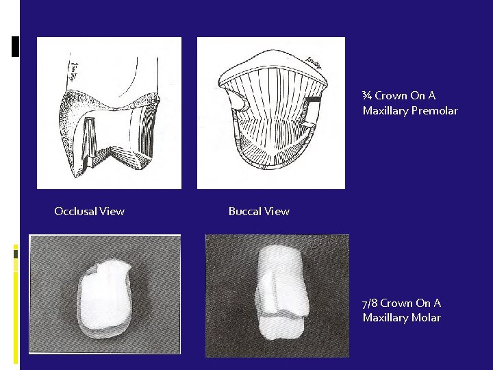 ¾ Crown On A Maxillary Premolar Occlusal View Buccal View 7/8 Crown On A