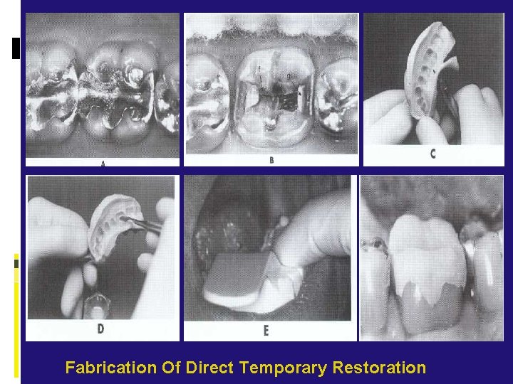 Fabrication Of Direct Temporary Restoration 