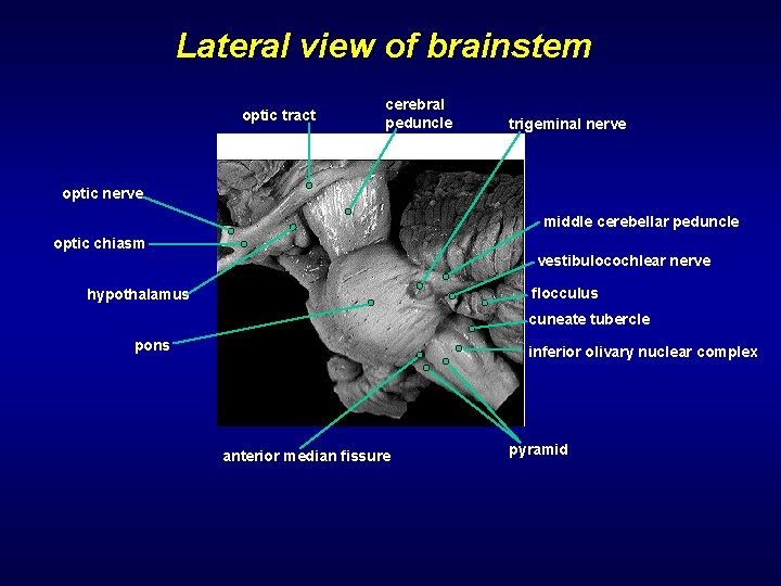 Lateral view of brainstem optic tract cerebral peduncle trigeminal nerve optic nerve middle cerebellar