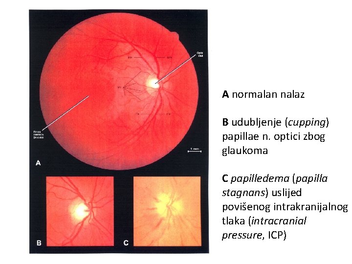 A normalan nalaz B udubljenje (cupping) papillae n. optici zbog glaukoma C papilledema (papilla
